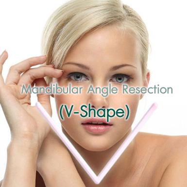 Mandibular Angle Resection (V-Shape)