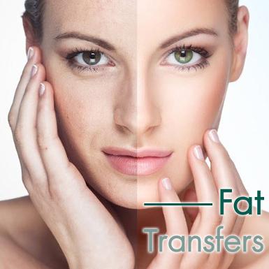 Fat Transfers